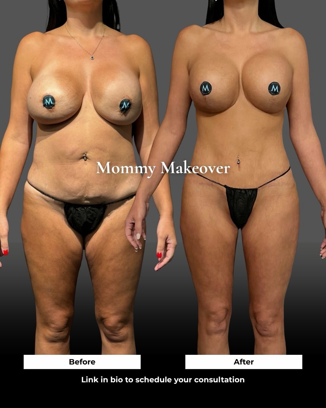 Mommy makeover before and after at Meadows Surgical Arts